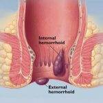 Sobanukirwa ibijyanye na hemorrhoids n’uburyo wahangana na yo hemorrhoids
