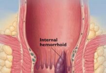 Sobanukirwa ibijyanye na hemorrhoids n’uburyo wahangana na yo hemorrhoids