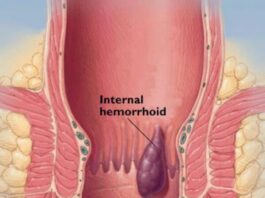 Sobanukirwa ibijyanye na hemorrhoids n’uburyo wahangana na yo hemorrhoids
