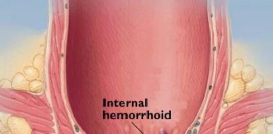 Sobanukirwa ibijyanye na hemorrhoids n’uburyo wahangana na yo hemorrhoids