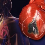 Impamvu 10 zishobora gutera ikibazo cyo guhagarara k’umutima Guhagarara k'umutima
