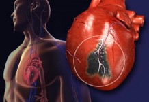Impamvu 10 zishobora gutera ikibazo cyo guhagarara k’umutima Guhagarara k'umutima