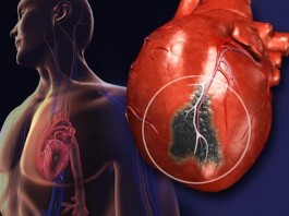Impamvu 10 zishobora gutera ikibazo cyo guhagarara k’umutima Guhagarara k'umutima