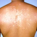 Ise: Indwara yibasira uruhu, ikiyitera, uko ivurwa n’uko wayirinda ise
