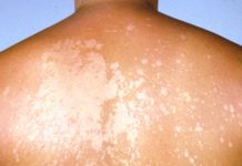Ise: Indwara yibasira uruhu, ikiyitera, uko ivurwa n’uko wayirinda ise